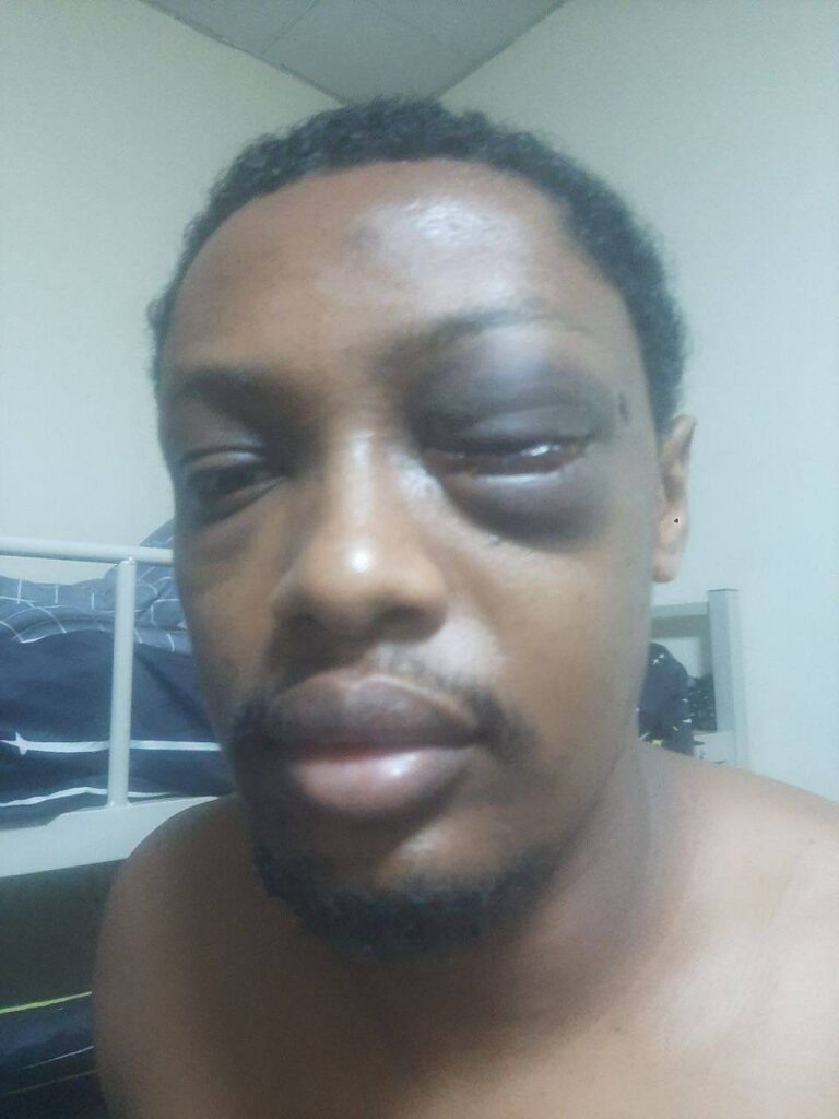 In this image provided by Ebisa, an engineer from Ethiopia, he is seen after a severe beating that left him blind in one eye at the Deko Park scam center in Myanmar where he said he was constantly punished - beaten, shocked, detained and forced to exercise for hours at a time - for failing to meet impossible performance goals. (Ebisa via AP)